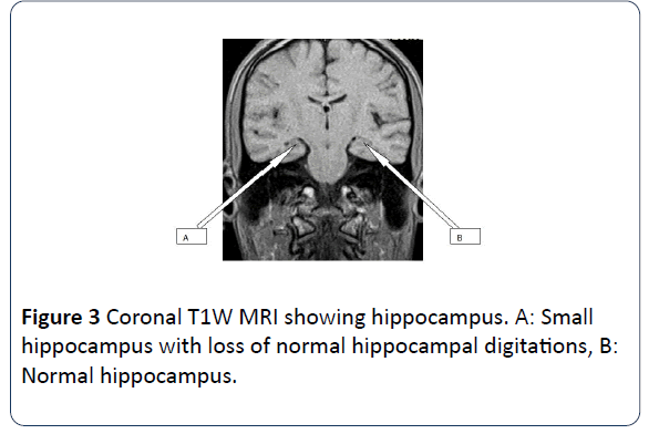 hsj-normal-hippocampal