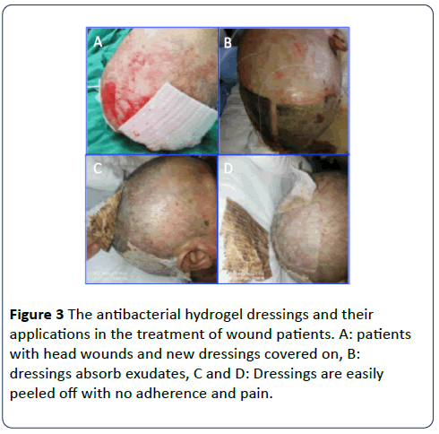 /hsj-wound-patients