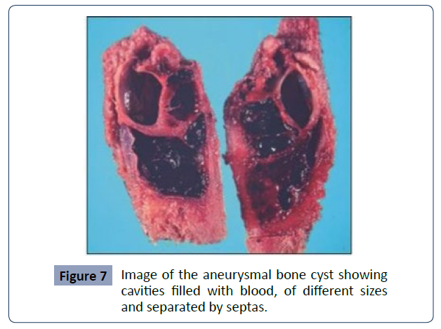 health-science-journal-aneurysmal