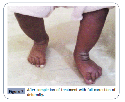 Cross Sectional Study Of Clinical Profile And Treatment Of Clubfoot By Ponseti Method Among Infants At A Tertiary Care Hospital Insight Medical Publishing Cross Sectional Study Of Clinical Profile And Treatment Of Clubfoot By Ponseti Method Among Infants At A Tertiary Care Hospital Insight Medical Publishing