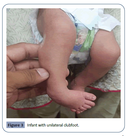 Cross Sectional Study Of Clinical Profile And Treatment Of Clubfoot By Ponseti Method Among Infants At A Tertiary Care Hospital Insight Medical Publishing