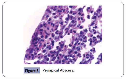 Periapical Abscess Histology